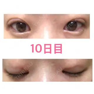 10日目の経過画像（1枚目）