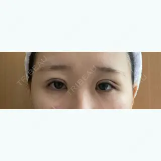 0日目の経過画像（2枚目）