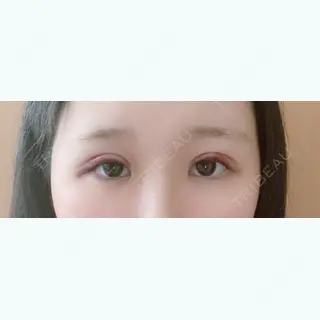 1日目の経過画像（1枚目）
