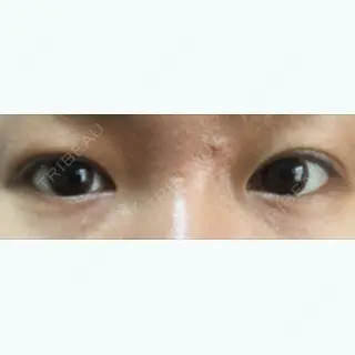 30日目の経過画像（1枚目）