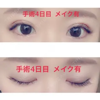 4日目の経過画像（1枚目）