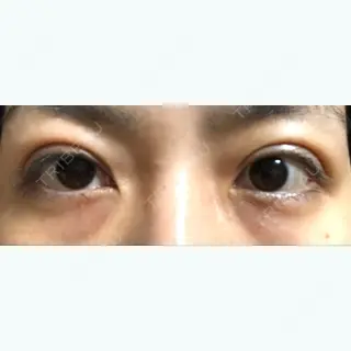 0日目の経過画像（1枚目）