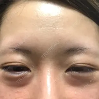0日目の経過画像（2枚目）