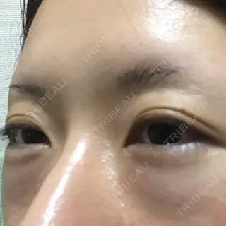 0日目の経過画像（2枚目）