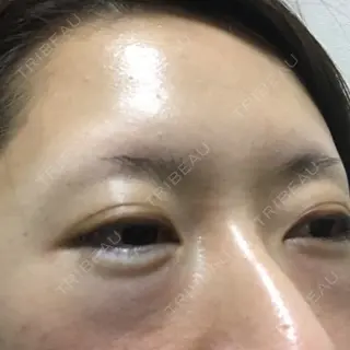 0日目の経過画像（3枚目）