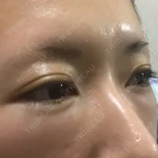 1日目の経過画像（3枚目）