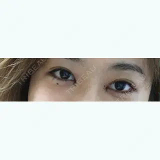 5日目の経過画像（1枚目）