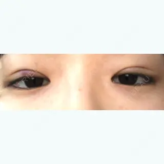 0日目の経過画像（3枚目）