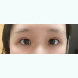 8日目の経過画像（1枚目）