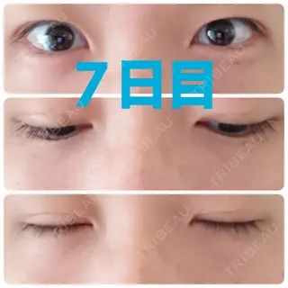 7日目の経過画像（1枚目）