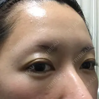 2日目の経過画像（3枚目）