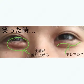 11日目の経過画像（2枚目）