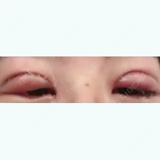 0日目の経過画像（1枚目）