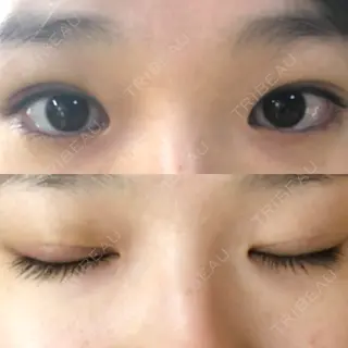 4日目の経過画像（1枚目）