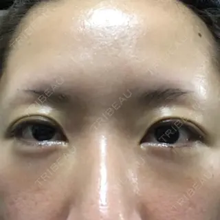 3日目の経過画像（1枚目）