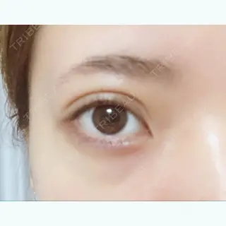 2日目の経過画像（1枚目）