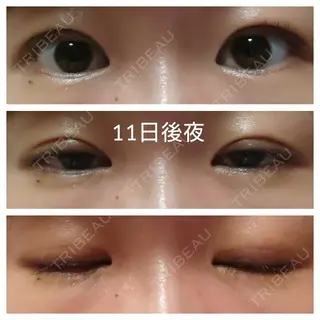 10日目の経過画像（1枚目）