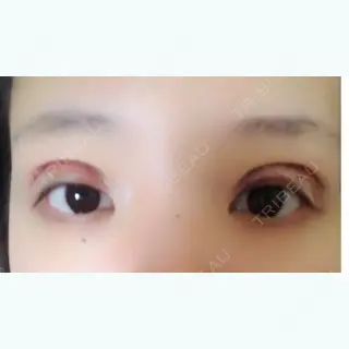 0日目の経過画像（1枚目）