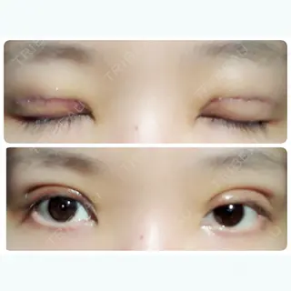 3日目の経過画像（1枚目）