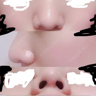 64日目の経過画像（1枚目）