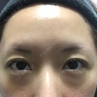 5日目の経過画像（1枚目）