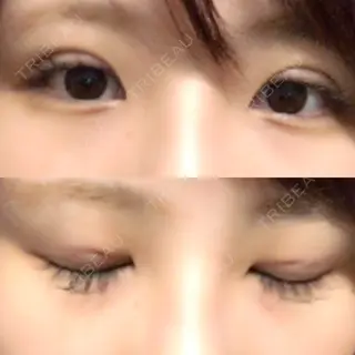 0日目の経過画像（1枚目）