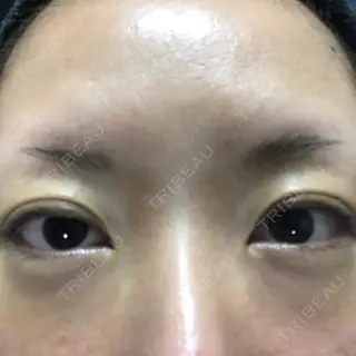 6日目の経過画像（1枚目）