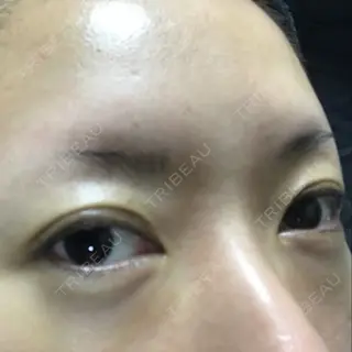 6日目の経過画像（3枚目）