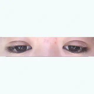 13日目の経過画像（2枚目）