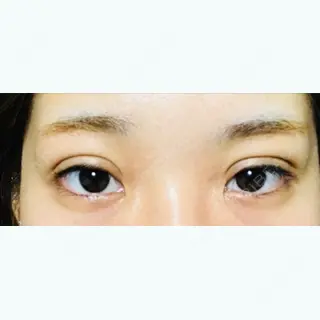 3日目の経過画像（1枚目）