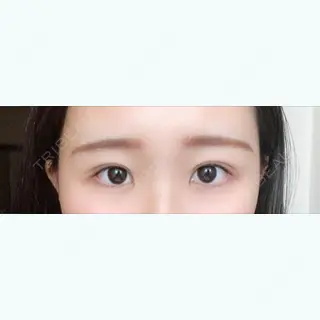 29日目の経過画像（1枚目）