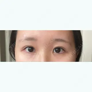 30日目の経過画像（2枚目）