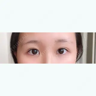 30日目の経過画像（1枚目）