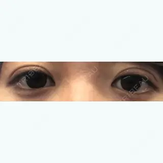 14日目の経過画像（1枚目）
