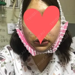 2日目の経過画像（1枚目）