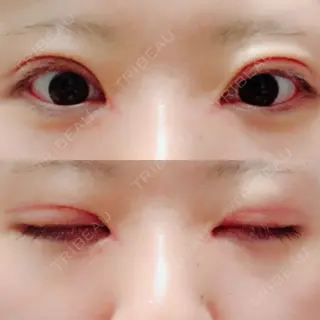 41日目の経過画像（1枚目）