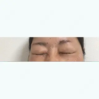 14日目の経過画像（1枚目）