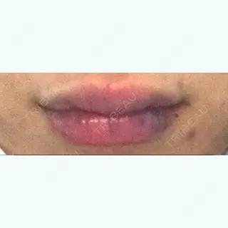 1日目の経過画像（1枚目）