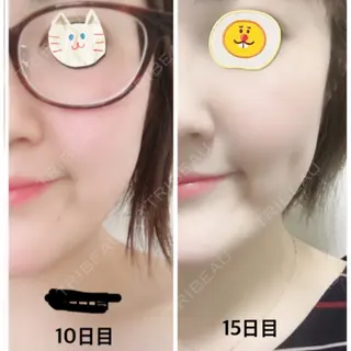 15日目の経過画像（1枚目）