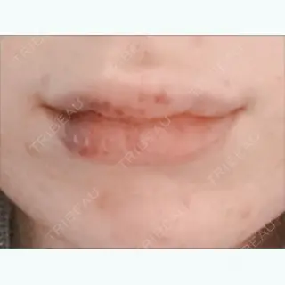 3日目の経過画像（1枚目）
