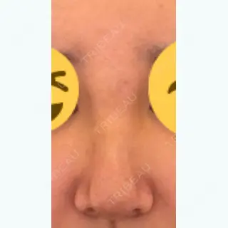 5日目の経過画像（1枚目）