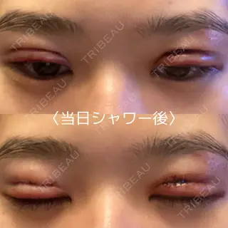 0日目の経過画像（1枚目）
