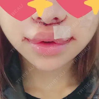 1日目の経過画像（1枚目）