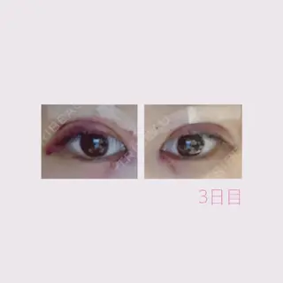 84日目の経過画像（1枚目）