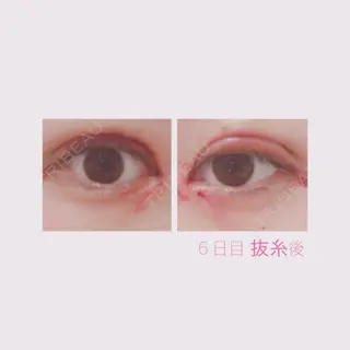 84日目の経過画像（1枚目）