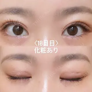 10日目の経過画像（1枚目）