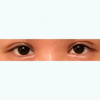 30日目の経過画像（2枚目）