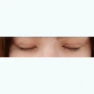 12日目の経過画像（2枚目）