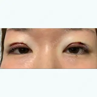 0日目の経過画像（1枚目）