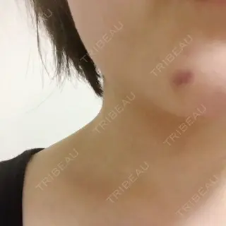 5日目の経過画像（1枚目）